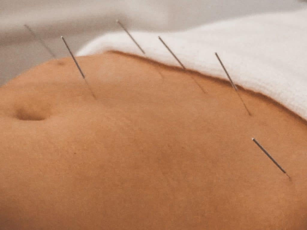 Akupunktur og IVF