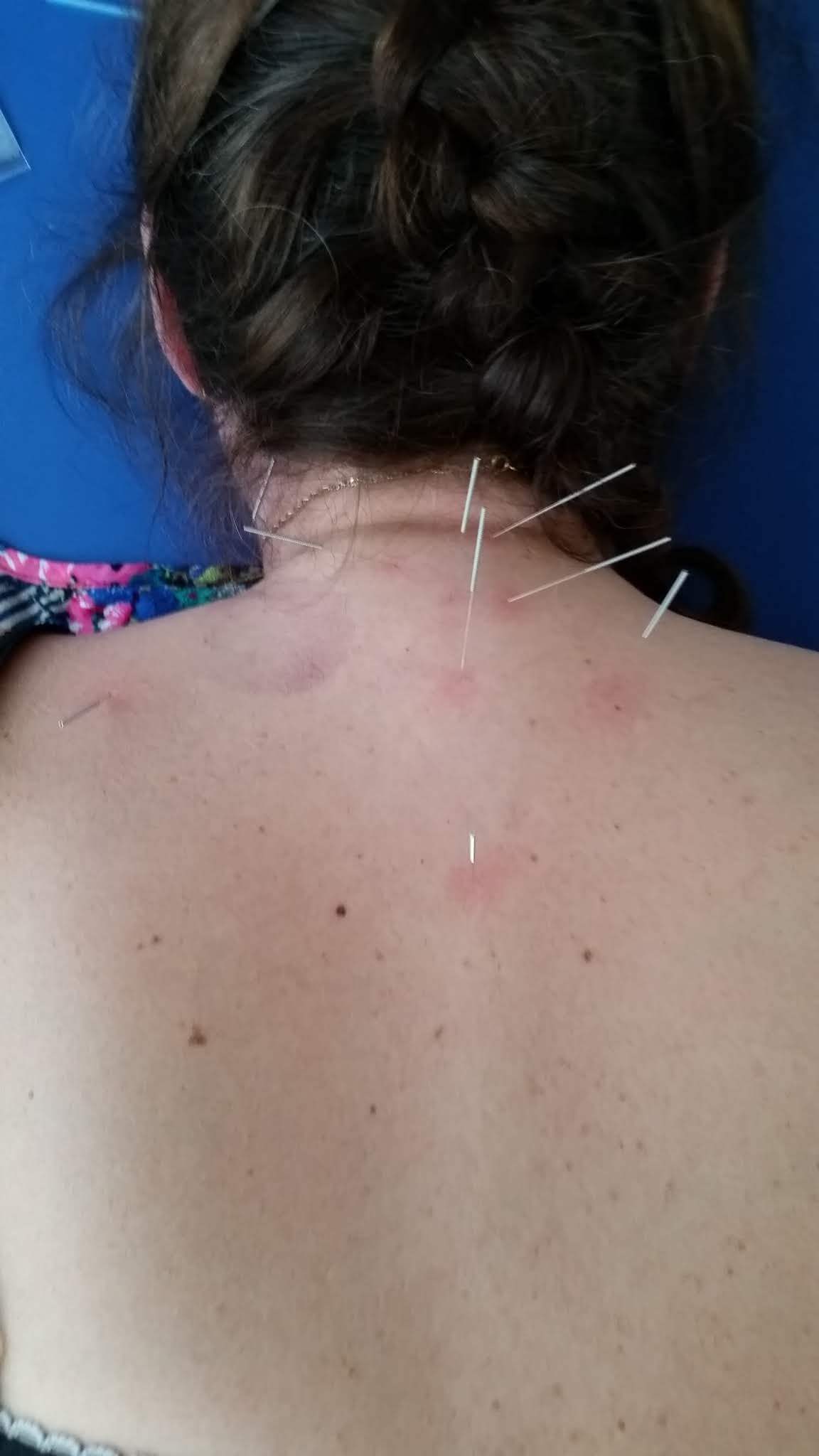 Acupunctuur bij pijn