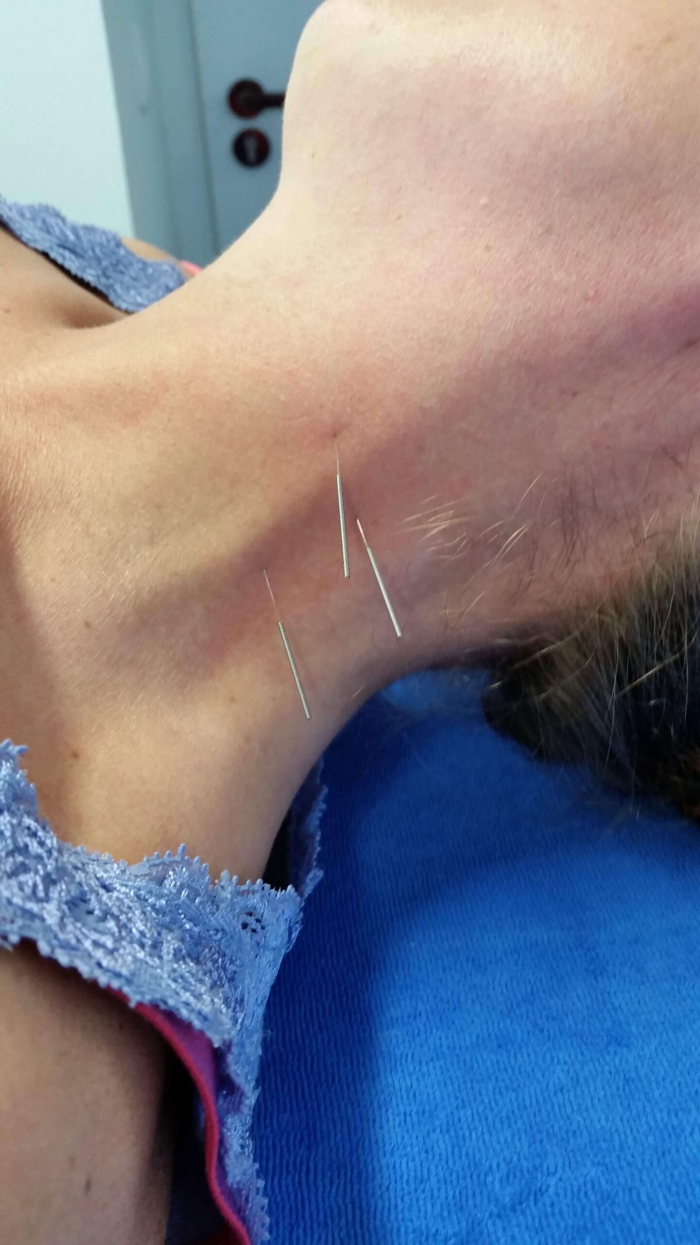 Neuropuncture