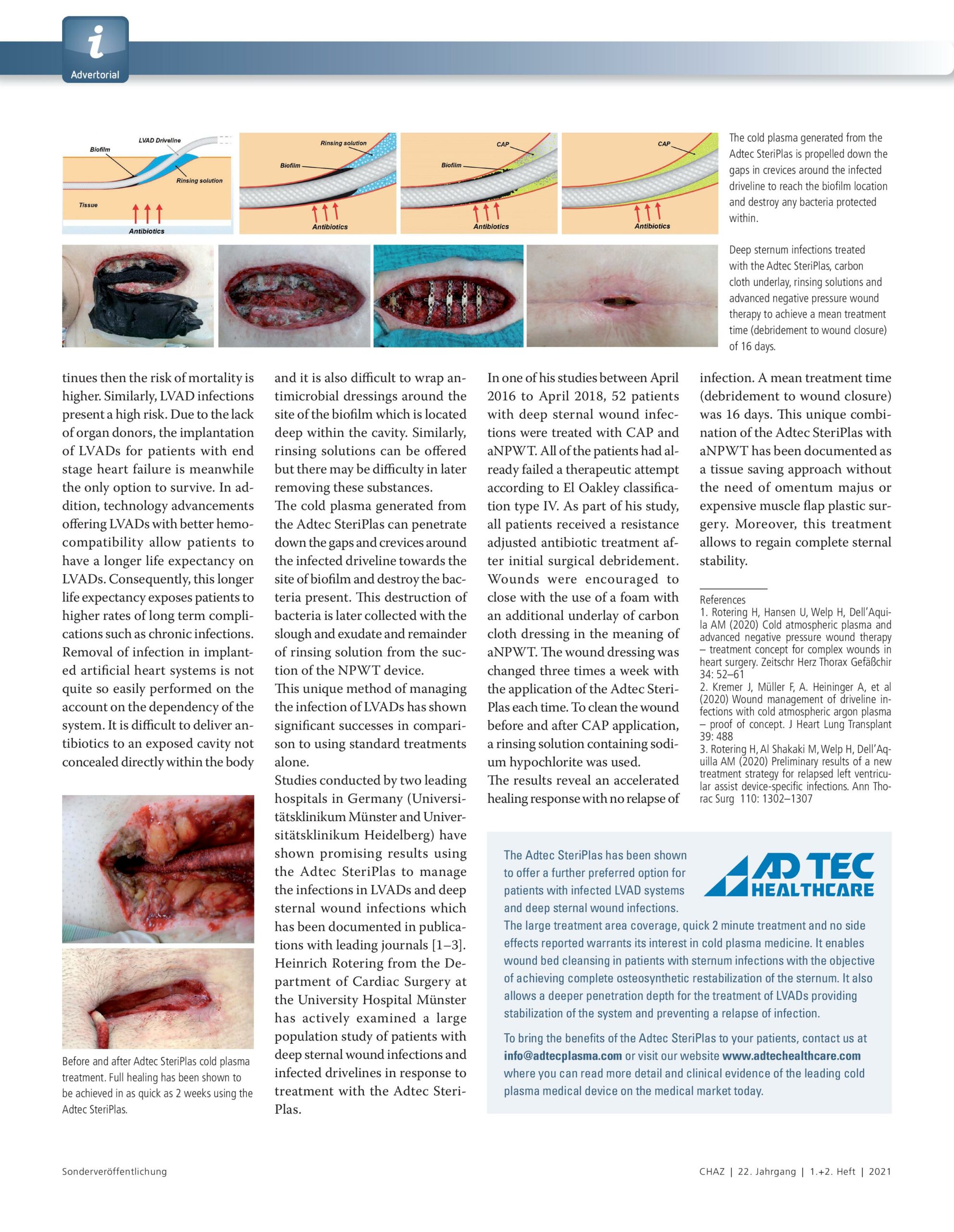 Adtec SteriPlas for the treatment of deep sternal wound infections and ...