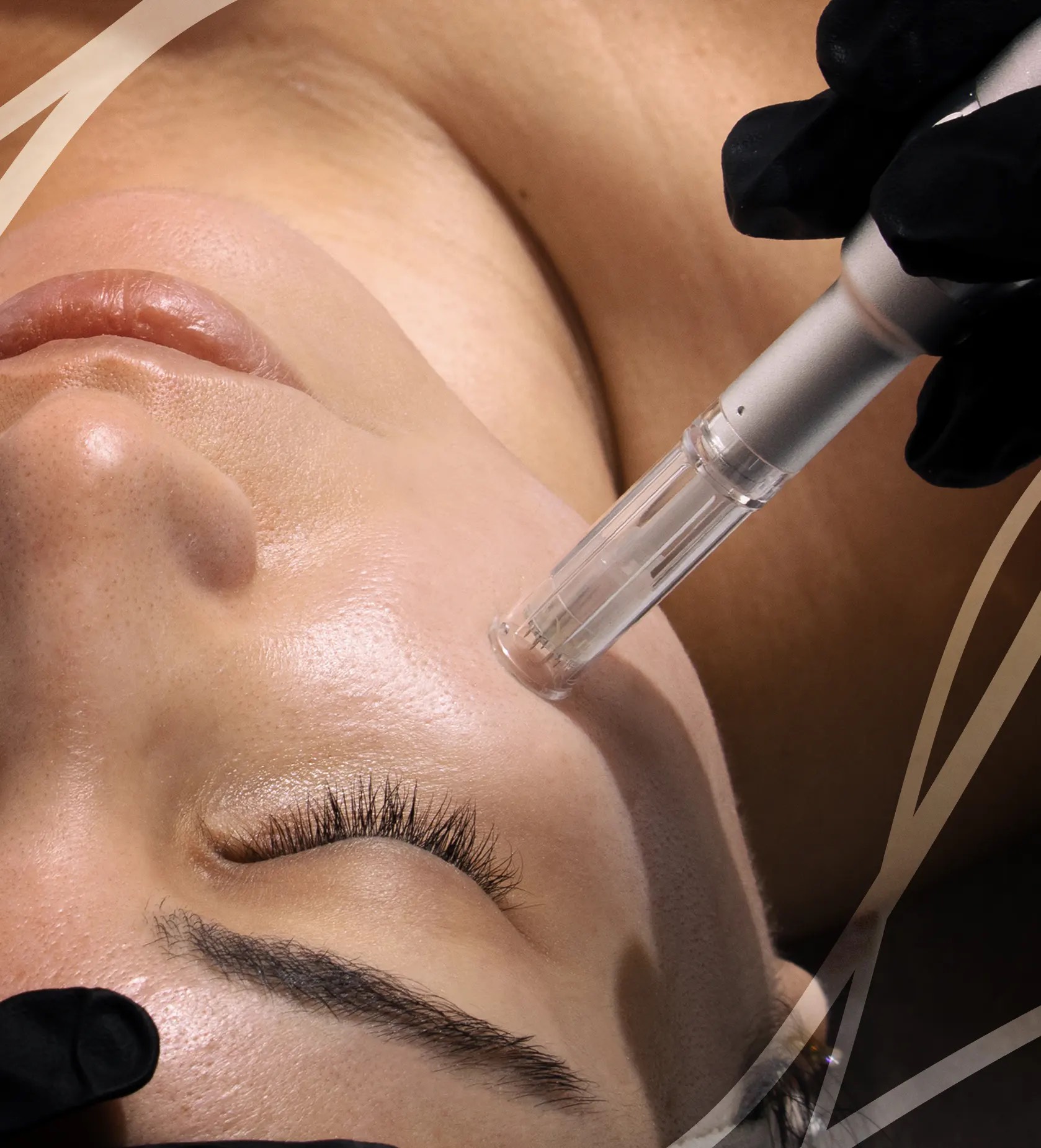 Microneedling, vägen till en friskare och mer strålande hud