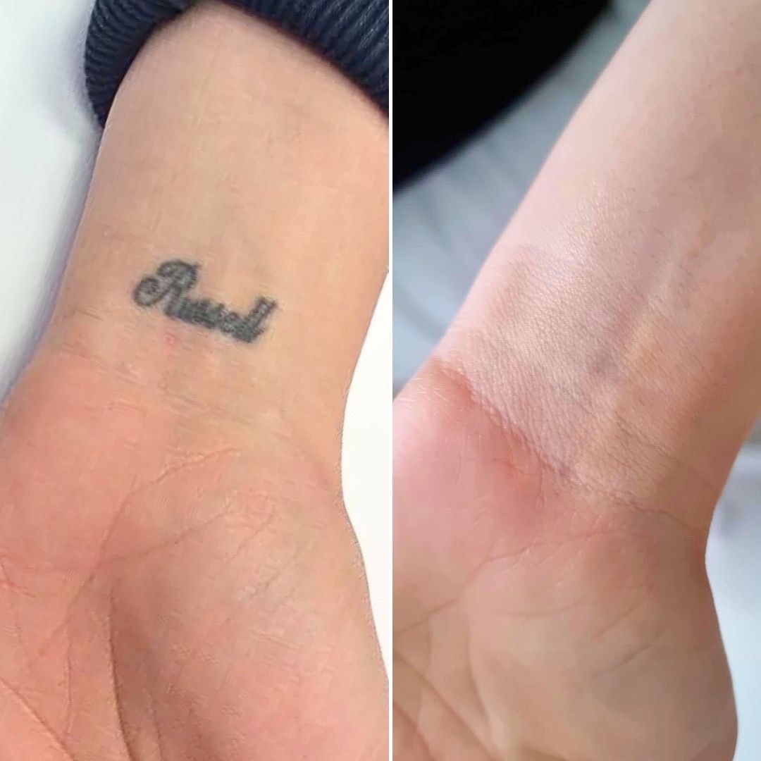 Ta bort din tatuering med Helios III – effektivt, säkert och professionellt hos Alma Laserkliniken