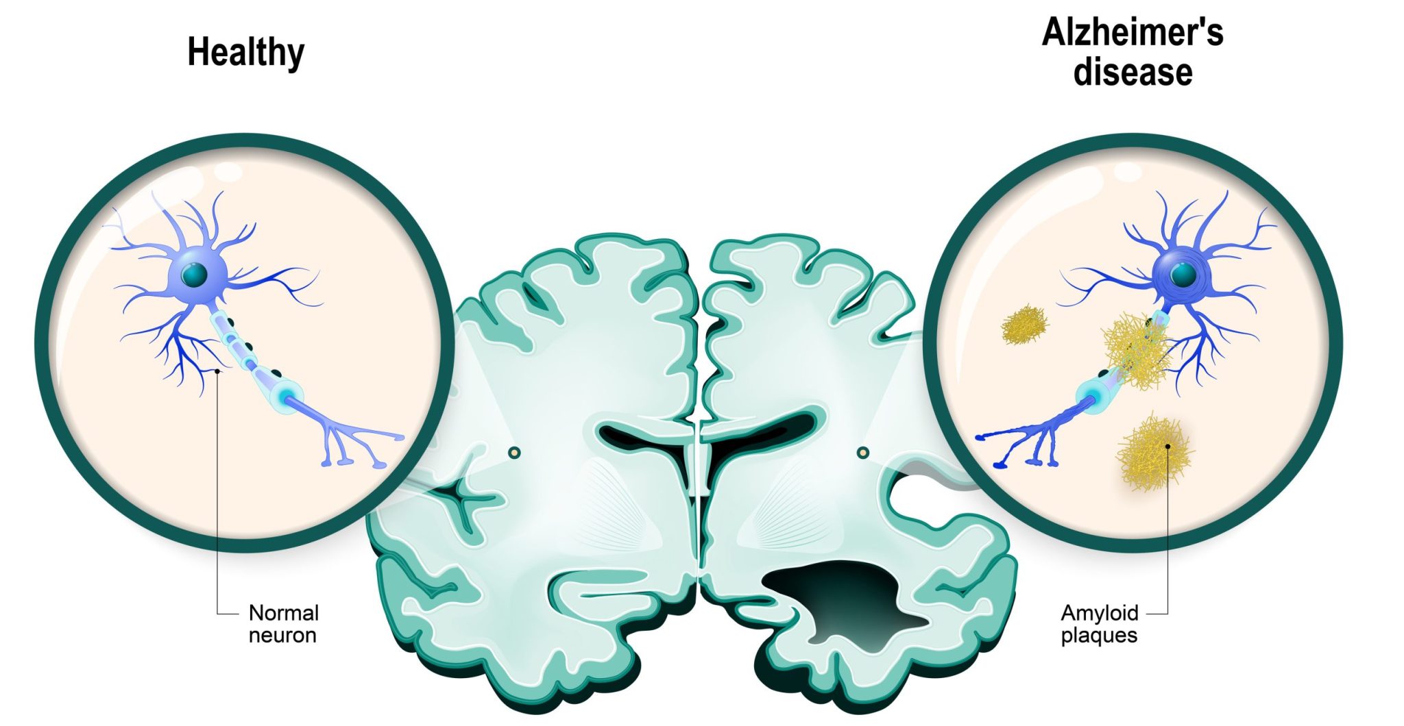 Alzheimer Alarm Könnte Ihr Körper Unter Lithiummangel Leiden Die Warnzeichen - gjq9ekh