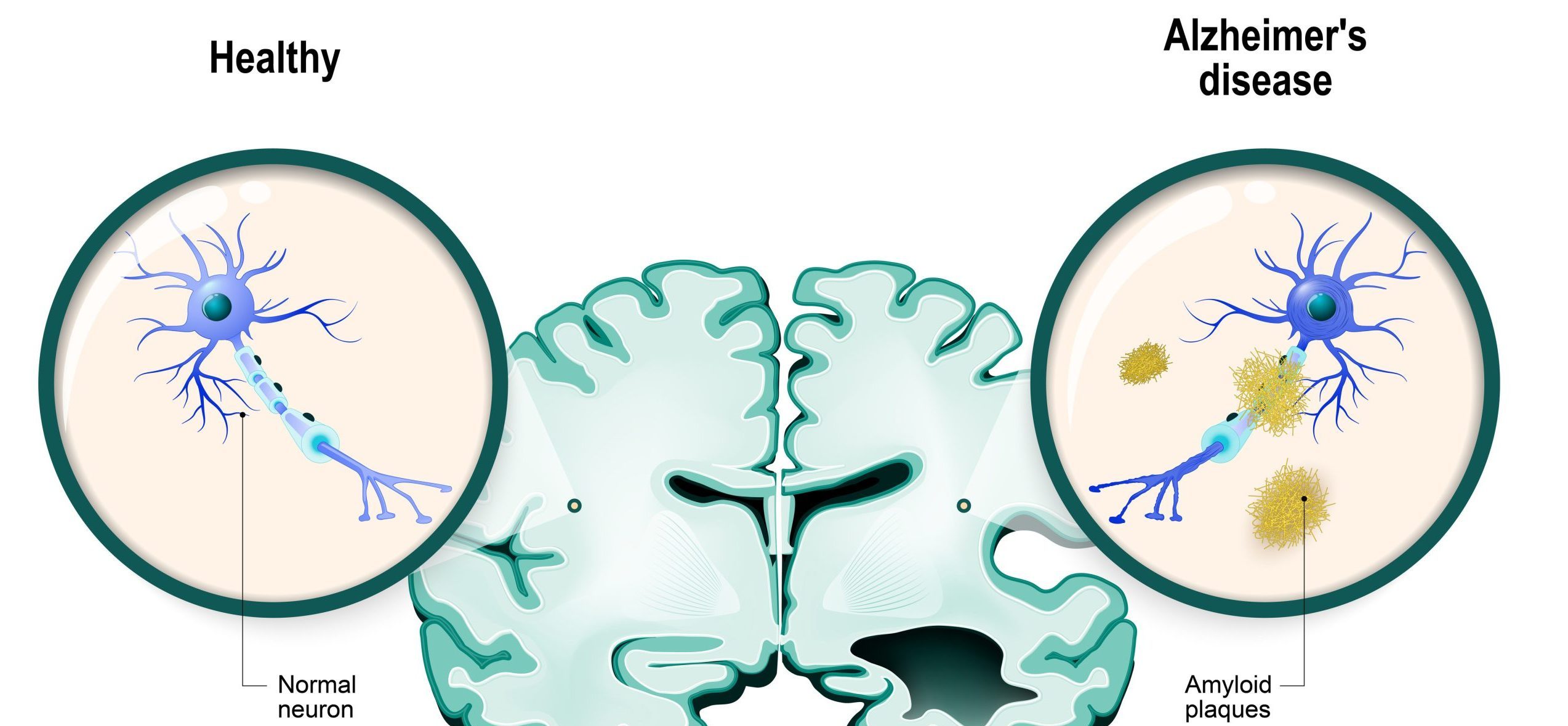 Ny amerikansk alzheimermedicin visar hoppfulla resultat!