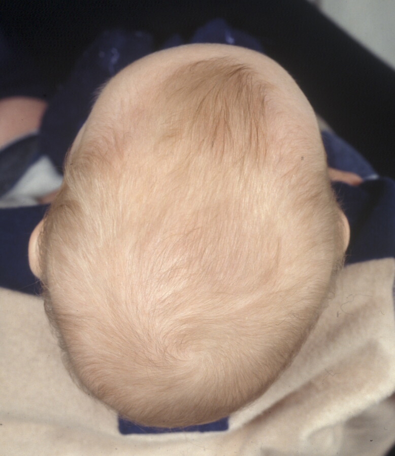 Flat Head Syndrome Prevent a Flat Head Baby Cloud