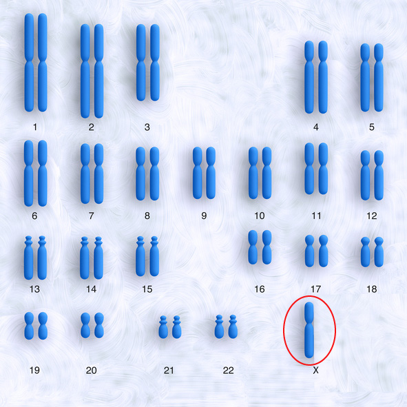 Turners syndrom, 45X