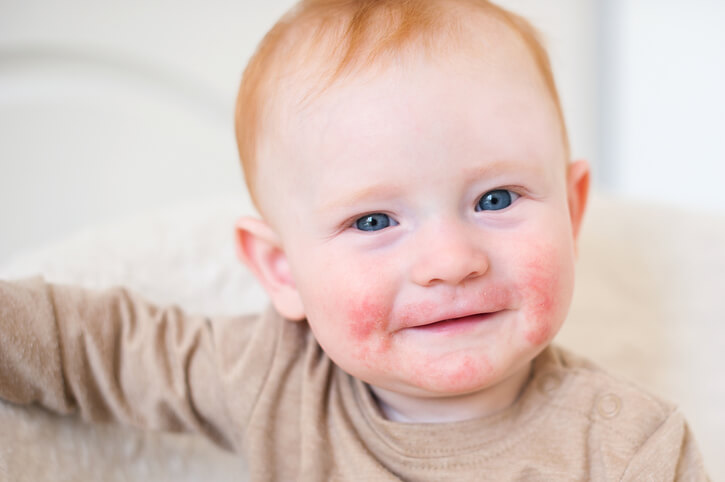 Allergi baby, er det måske allergi dit barn har? har ⇒