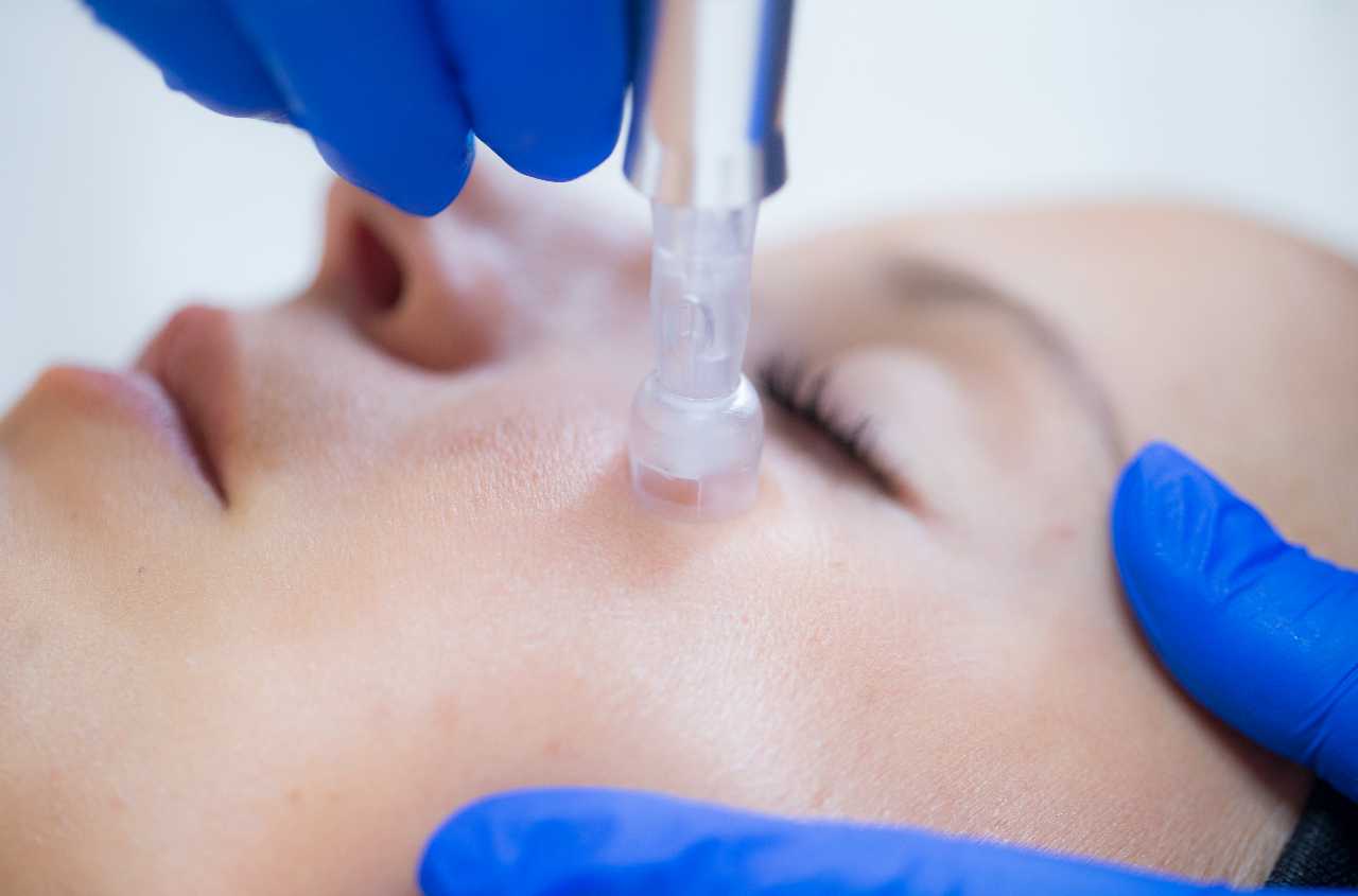 micro needling ansigtsbehandling beautysolution