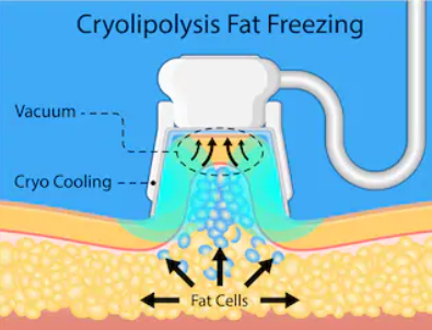 Vad är coolsculpting