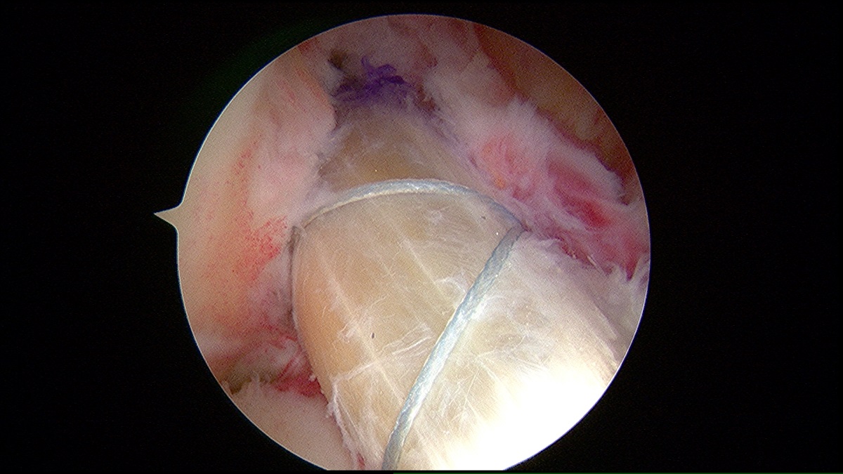 ACL reconstructed using hamstring graft bjj