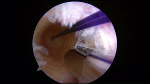 Femoral tunnel for ACL graft bjj