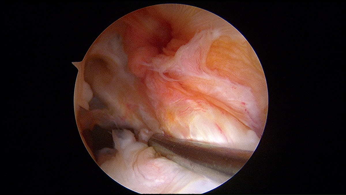 Torn unstable ACL, bjj