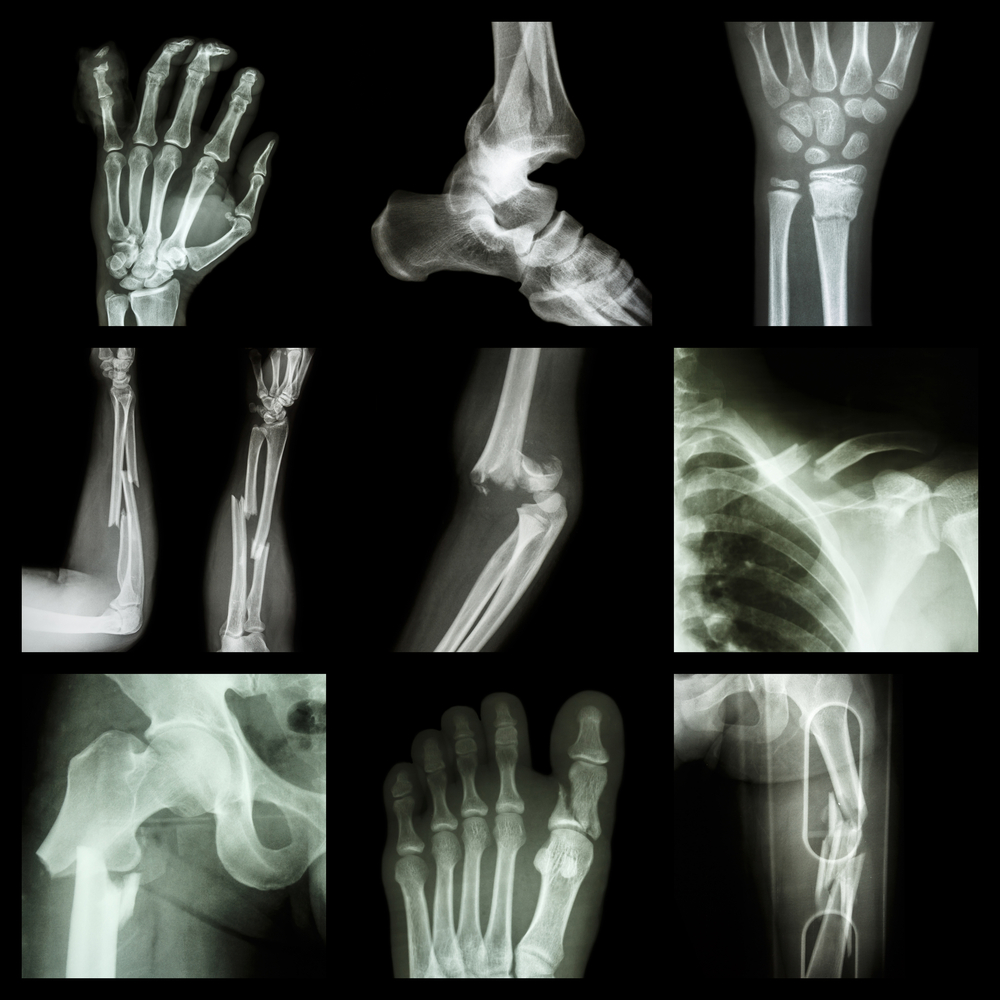 collection of x-rays - fracturted bones