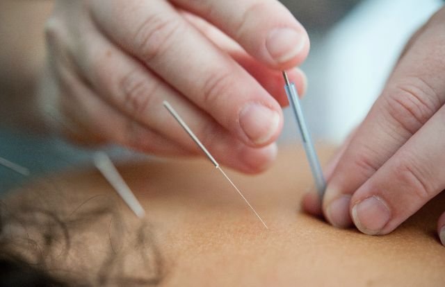 Acupuncture for infertility