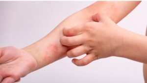 Why Childhood Eczema Sometimes Persists into Adulthood