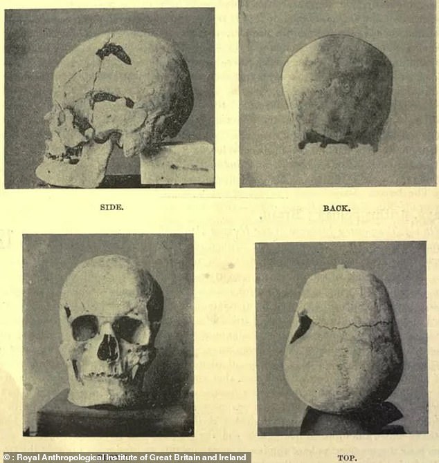 The earliest confirmed case of giantism is Sa-Nakht (pictured), an ancient Egyptian pharaoh from 2700 BC, who is believed to have been 6 feet 1.6 inches (1.987m)