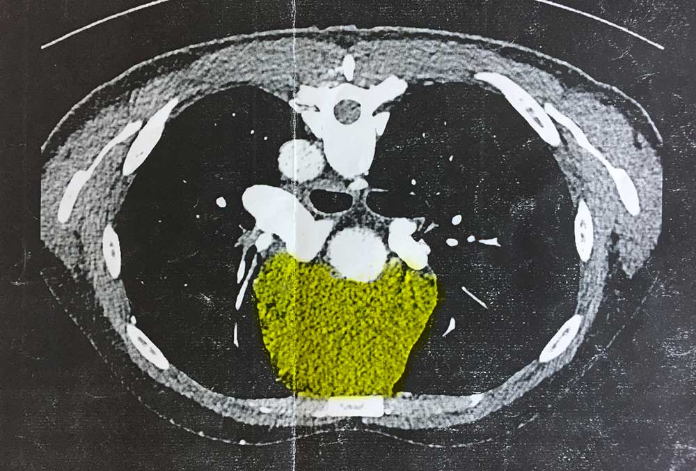 CT-röntgenresultat. Visar en tumör stor som en tennisboll precis bakom bröstbenet.