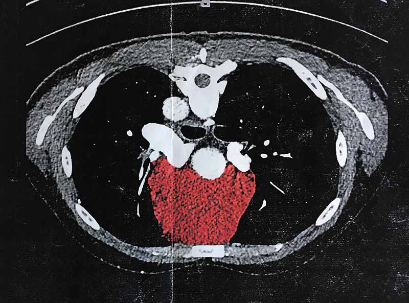 CT-röntgen resultat. Visar en tumör stor som en tennisboll precis bakom bröstbenet.