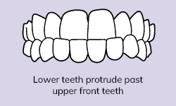 Underbite