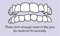 Crooked Teeth