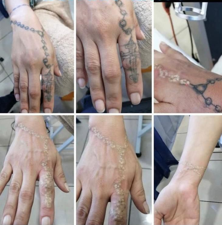 Aclarado de tatuaje para cover Eliminar tatuajes en Córdoba centro láser Mía