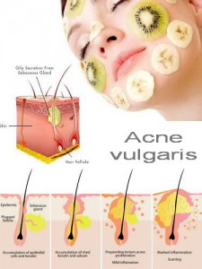 Acne vulgaris