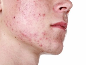 Hur man behandlar acne och förebygger akneärr. Läs några tips.