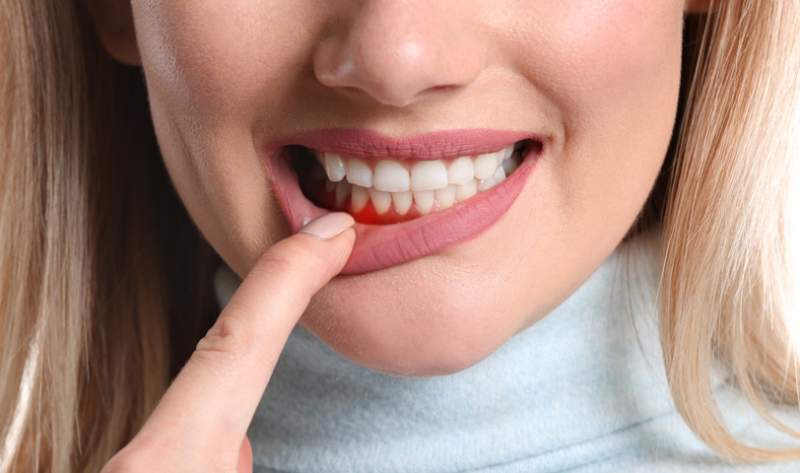 Blödande tandkött – vad ska man göra?