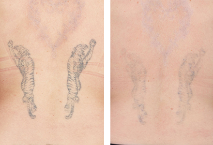 Pico Laser Ultra | Tatoveringsfjernelse efter 1 behandling