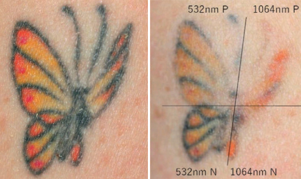 Pico Laser Ultra | Tatoveringsfjernelse efter 1 behandling