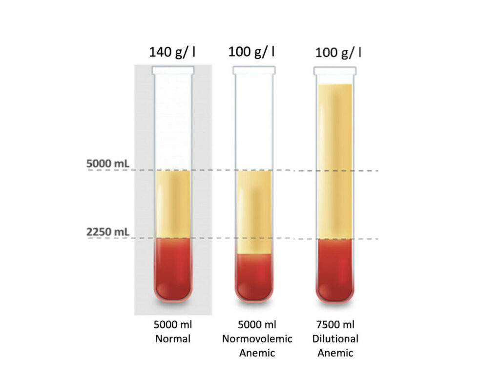 Illustration of Dilutional Anemia