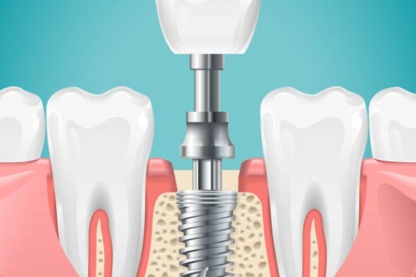 Dental surgery. Tooth implant cut vector illustration. Healthy teeth and dental implant, stomatology poster. Implant dental metal screw in gum