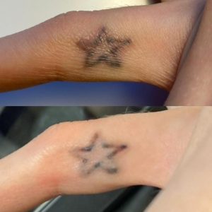 Tattoo entfernen Pforzheim PhiRemoval