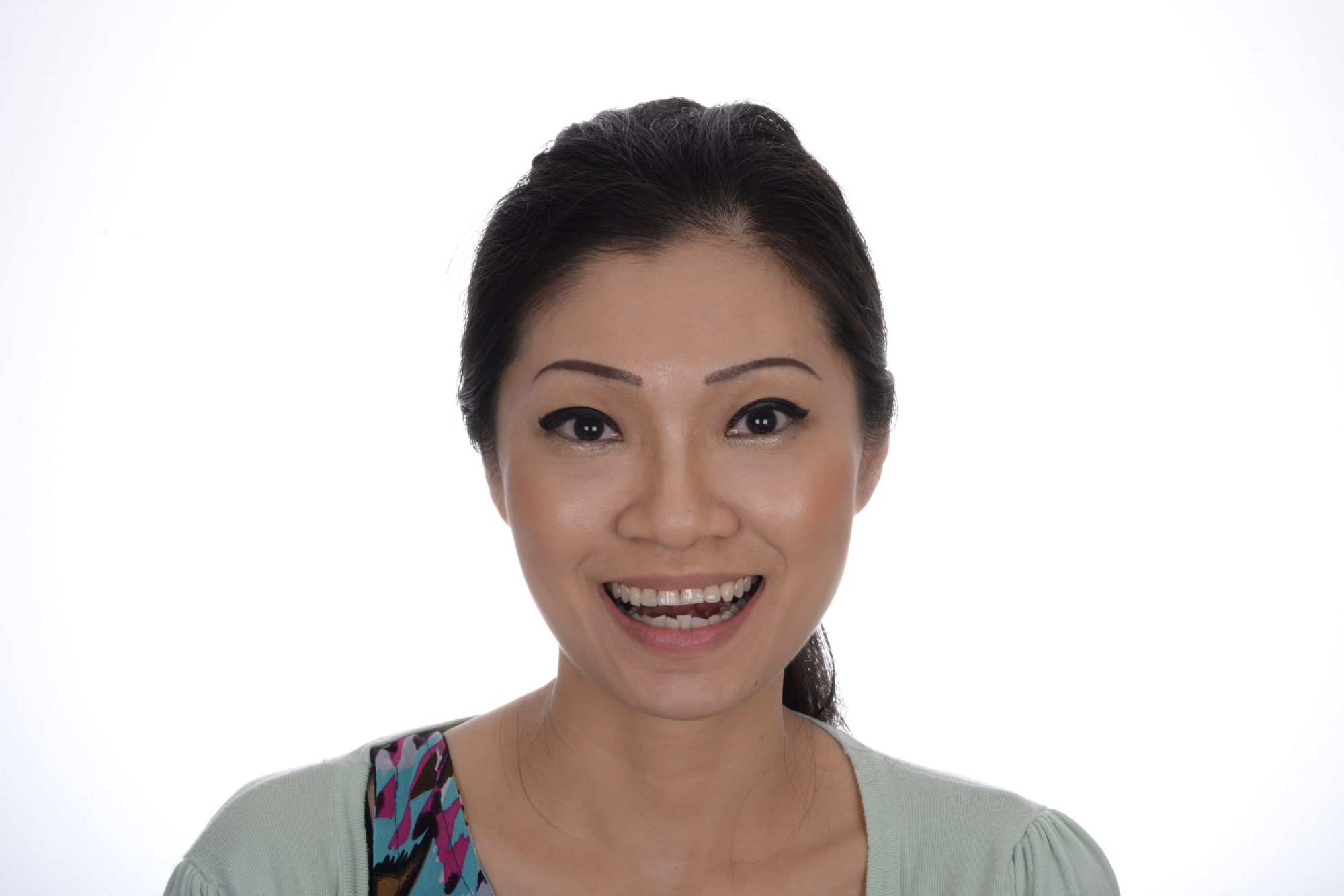 1-1 smile makeover patient 004 before