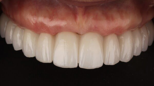 11.2 all-on-4 patient 011 after