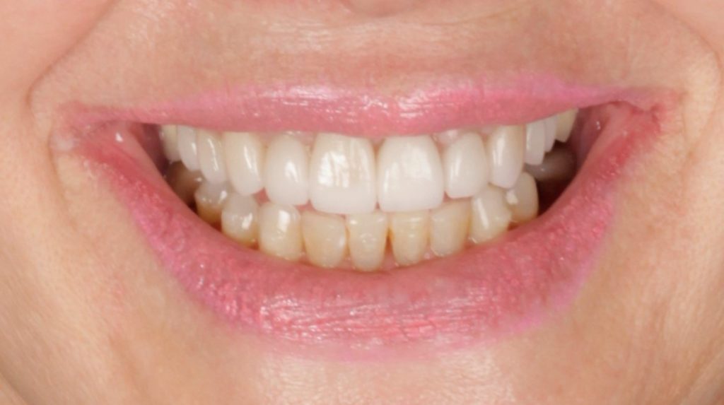 2-after-1024×573 Full Mouth Reconstruction patient 001 after