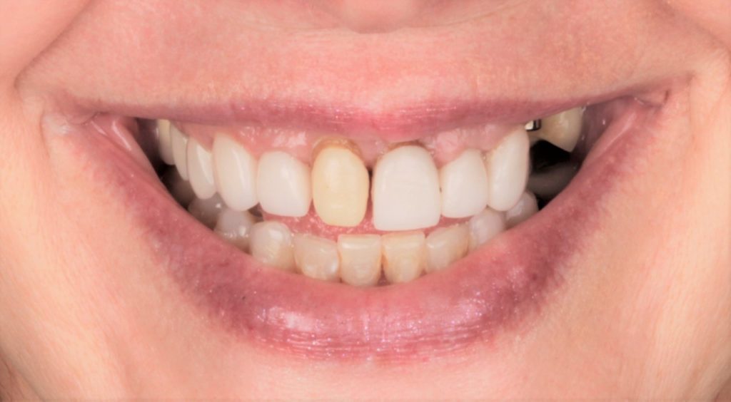 2-before-1024×564 Full Mouth Reconstruction patient 001 before