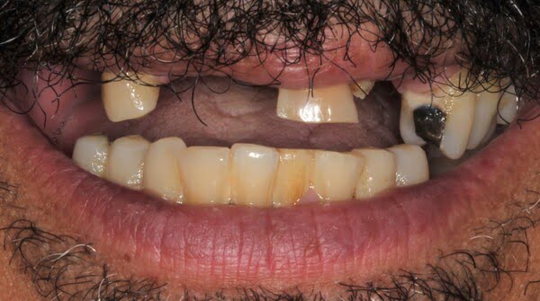 2.1 all-on-4 patient 002 before