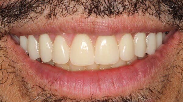 2.2 all-on-4 patient 002 after