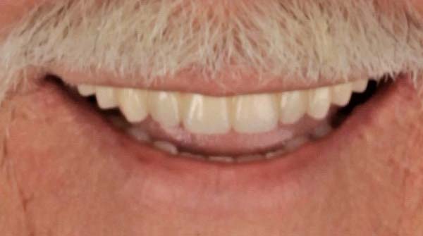 3-after Full Mouth Reconstruction patient 002 after