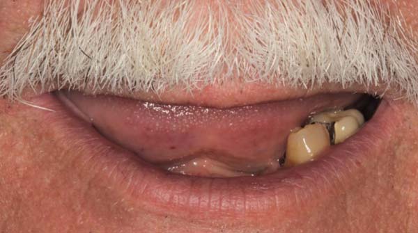 3-before Full Mouth Reconstruction patient 002 before