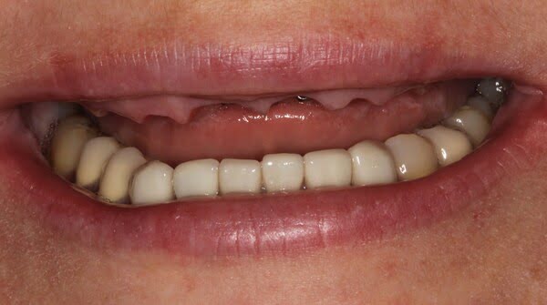 3.1 all-on-4 patient 003 before