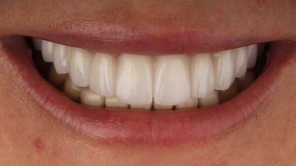 3.2 all-on-4 patient 003 after