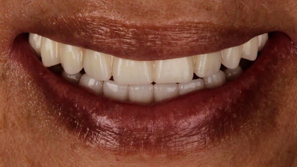 4.1 all-on-4 patient 004 after