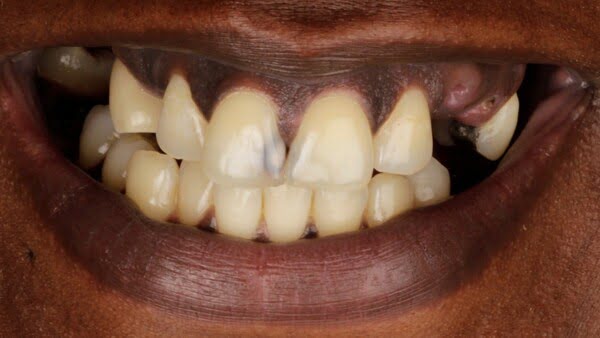 5.1 all-on-4 patient 005 before