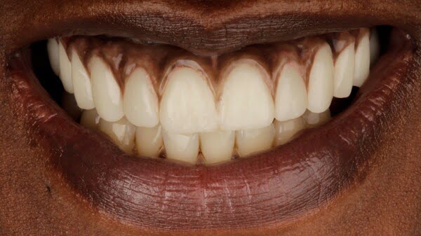 5.2 all-on-4 patient 005 after