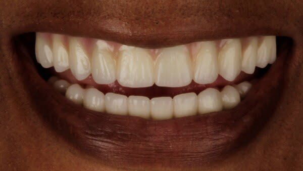 7.1 all-on-4 patient 007 after
