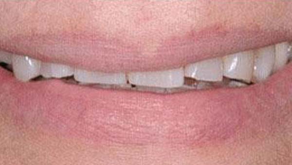 makeover-001-b4 smile makeover patient 001 before