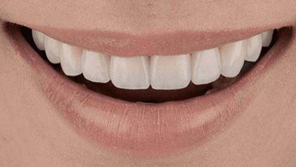 porcelain-001-after porcelain veneers patient 001 after