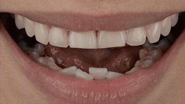 porcelain-001-b4 porcelain veneers patient 001 before